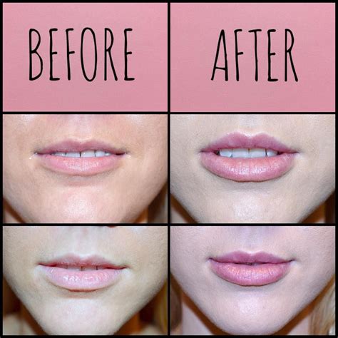 lip fillers near me ava|More.